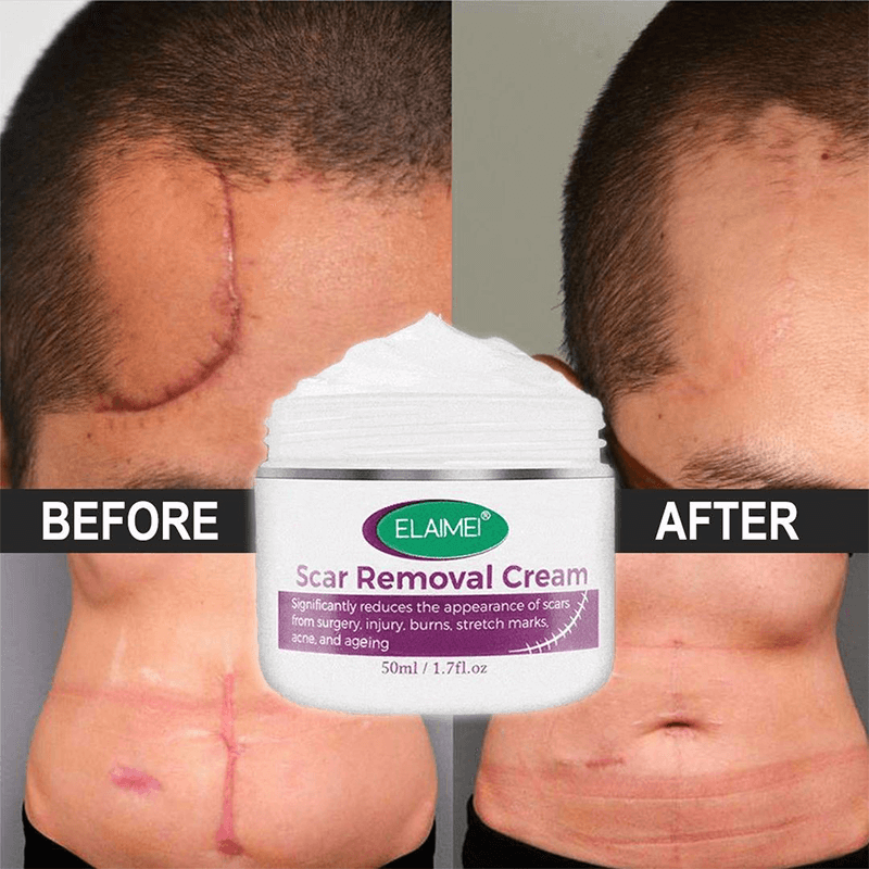 Scarless Skin Rebound Cream - Scar Removal Cream - Acnes Scar Cream