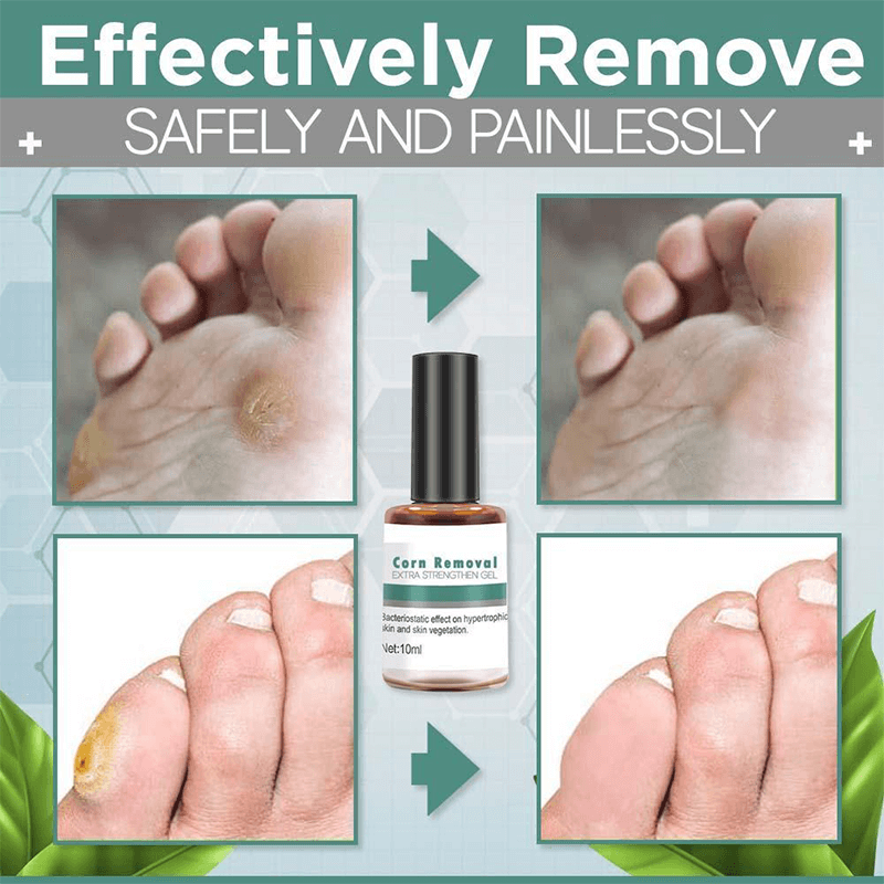 Foot Corn Removal Extra Strengthen Gel